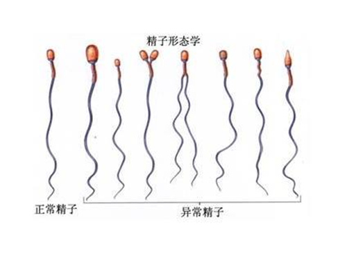 男性不育症也要重视，畸形精子症一定要了解！